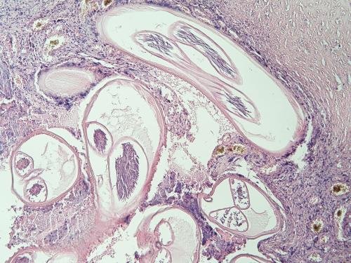 Onchocerca volvulus