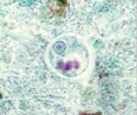 Entamoeba histolytica