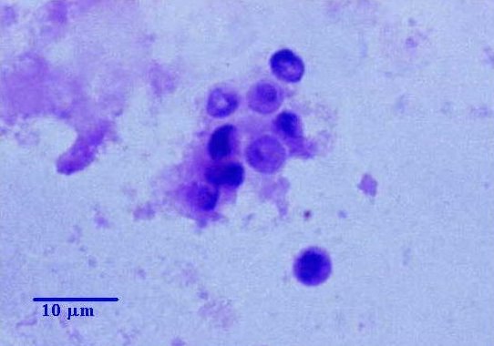 Pneumocystis jiroveci
