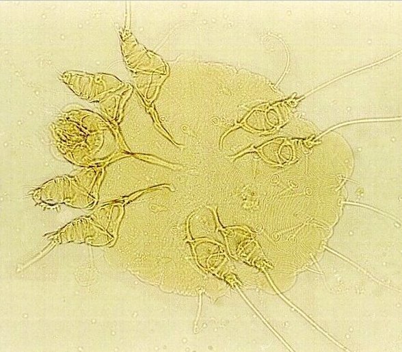 Sarcoptes scabiei